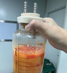 弥勒水动力吸脂手术要做多久？